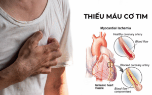 Thiếu máu cơ tim có nguy hiểm không?