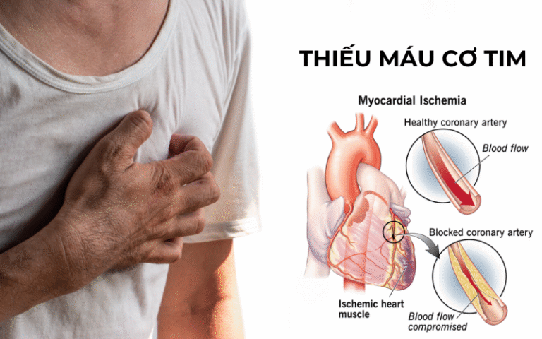 Thiếu máu cơ tim có nguy hiểm không?