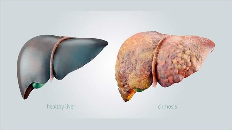 Triệu chứng ung thư gan giai đoạn cuối và cách để cải thiện tiên lượng