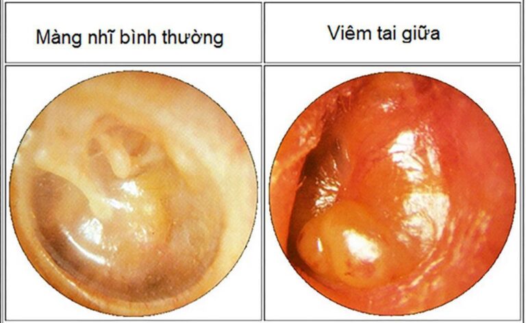 Triệu chứng viêm tai giữa ở người lớn và mẹo chữa trị nhanh khỏi