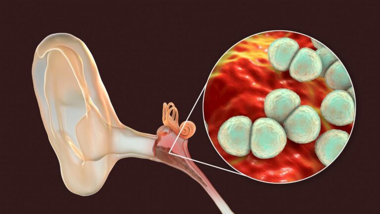 Bệnh viêm tai giữa: Điều trị đơn giản – Chẳng còn hoang mang!
