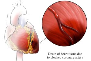Bệnh thiếu máu cơ tim cục bộ là gì? Ai dễ mắc bệnh thiếu máu cơ tim cục bộ?