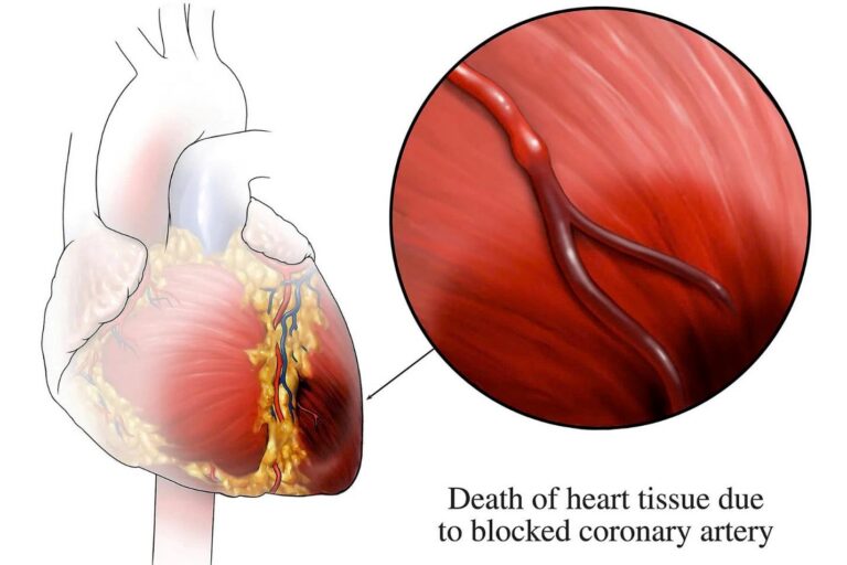 Bệnh thiếu máu cơ tim cục bộ là gì? Ai dễ mắc bệnh thiếu máu cơ tim cục bộ?