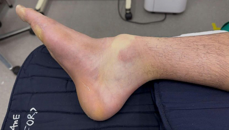 Một bệnh nhân bị chấn thương gãy trật cổ chân phức tạp khi chơi Pickleball.