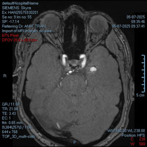 Auditory Hallucinations and Seizures Caused by a Rare Deep-Rooted Brain Tumour