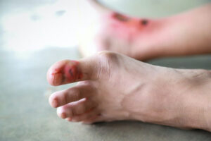 Male Patient Nearly Loses Life from Small Leg Scratch