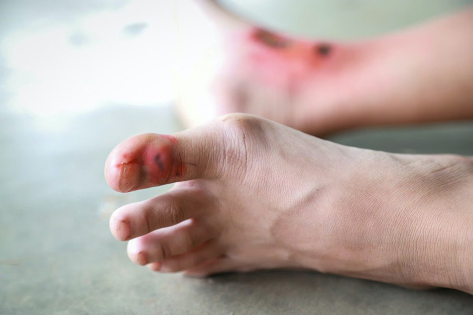 Trong trường hợp người bị suy giảm miễn dịch, vết loét gây hoại tử có thể hình thành từ một vết thương nhỏ ở chân.