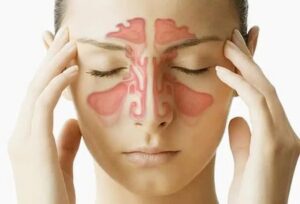 5 Biểu hiện của viêm xoang nặng cần điều trị ngay để tránh biến chứng