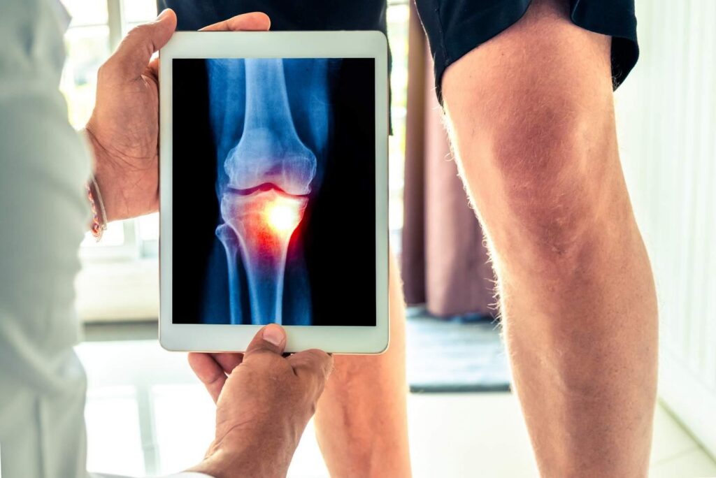 7 dấu hiệu đứt dây chằng đầu gối thường gặp nhất