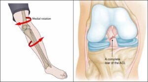 Đứt dây chằng chéo trước có phải mổ không? Giải pháp điều trị tối ưu là gì?