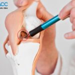 Đứt dây chằng gối có đi lại được không và mất bao lâu để hồi phục?