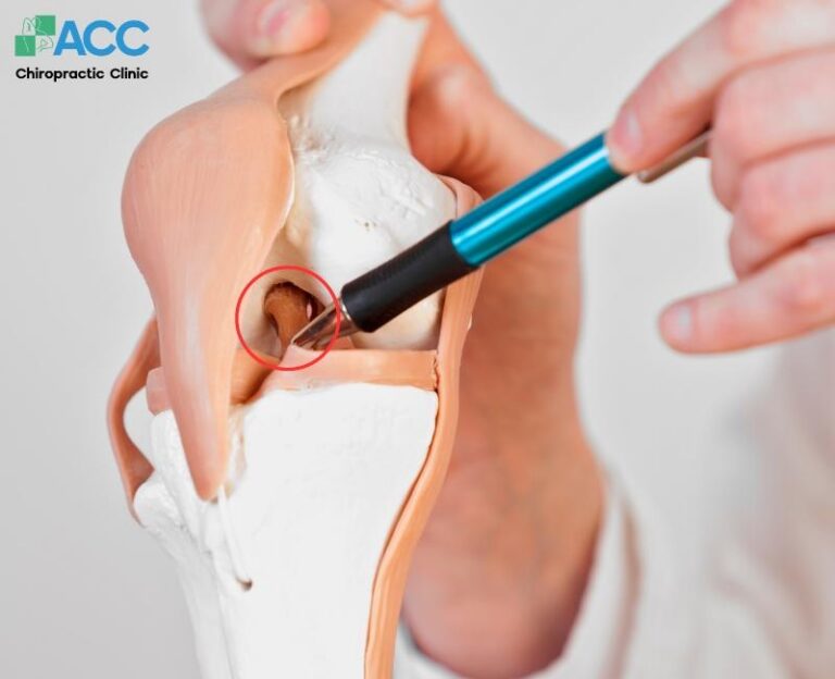 Đứt dây chằng gối có đi lại được không và mất bao lâu để hồi phục?