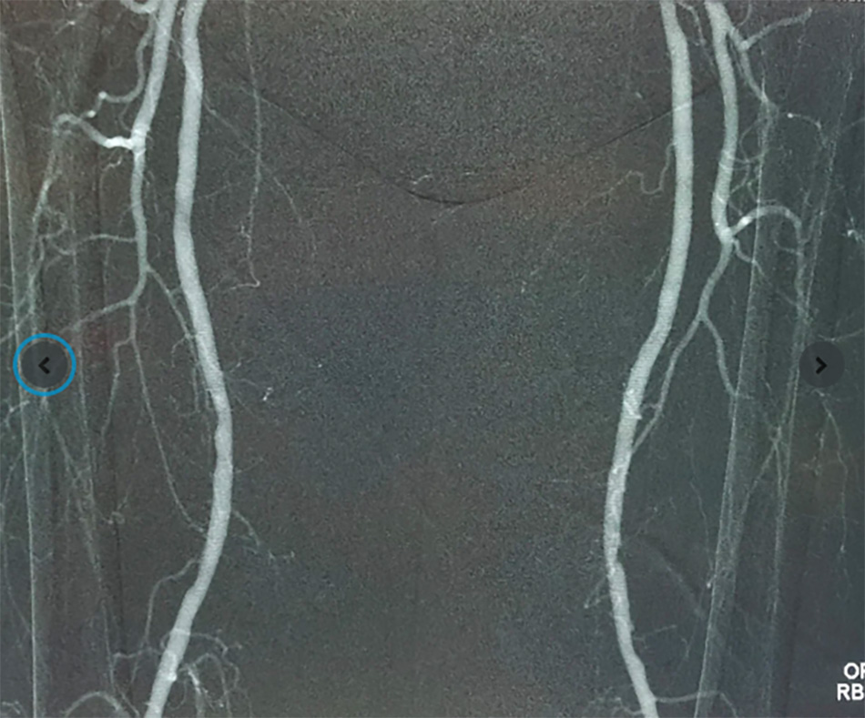 Khí CO₂ y tế tinh khiết được bơm vào cơ thể cho ra hình ảnh X-quang chất lượng cao. Ảnh: Angiodroid