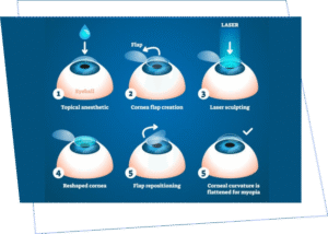 Mổ mắt cận thị LASIK: Giải pháp cải thiện thị lực an toàn hay tiềm ẩn rủi ro?