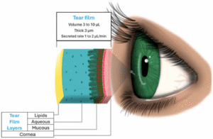 Mổ mắt chữa cận thị: Nên hay không?