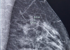 61-Year-Old Patient Escapes Advanced Breast Cancer Thanks to Routine Screening