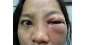 Triệu chứng viêm xoang: Nhận biết sớm để điều trị đúng, tránh biến chứng nguy hiểm