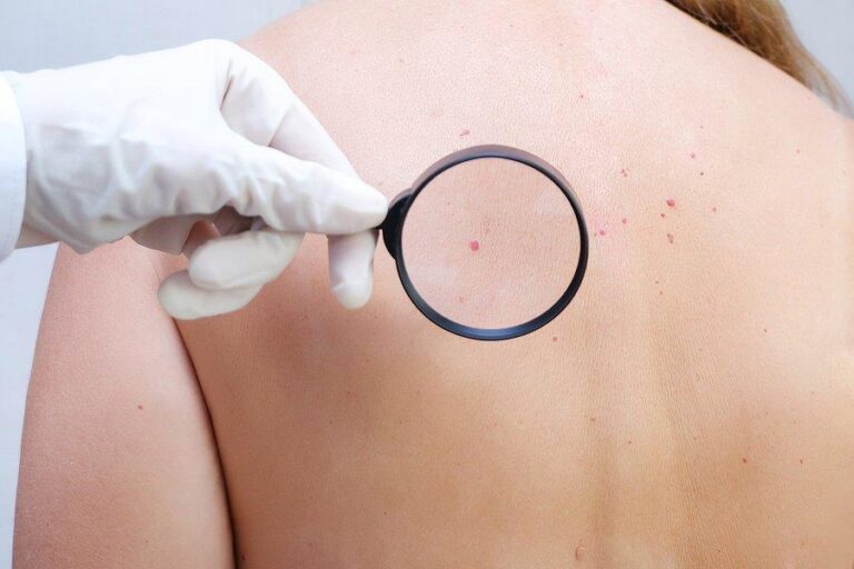Ung thư da giai đoạn cuối: Liệu có còn cơ hội điều trị hay chỉ là cuộc đua tuyệt vọng với thời gian?