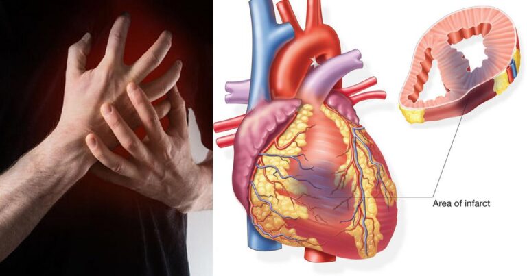 Bệnh nhồi máu cơ tim là gì? Bệnh nhồi máu cơ tim có di truyền không?