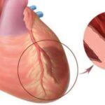Biểu hiện nhồi máu cơ tim: Cách nhận biết sớm và xử trí đúng để cứu tim kịp thời
