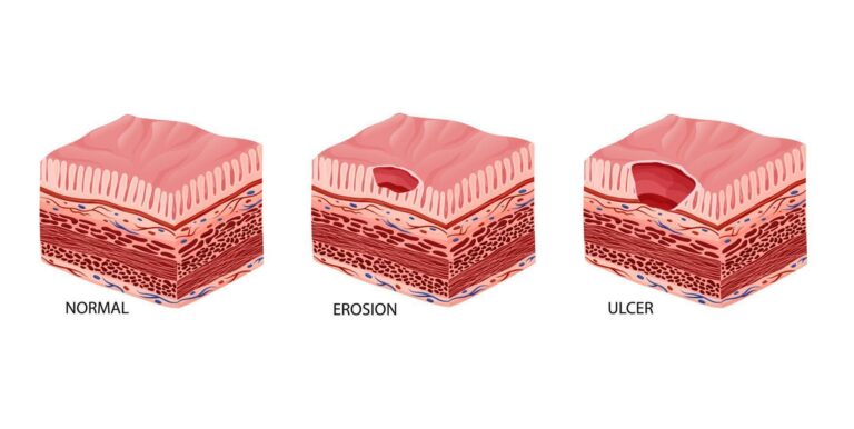 10 dấu hiệu viêm loét dạ dày đã trở nặng