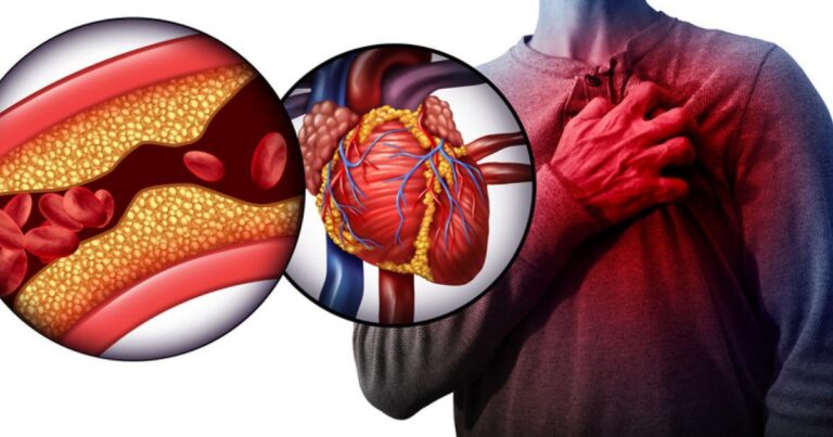 Nguyên nhân nhồi máu cơ tim là gì? 8 yếu tố nguy cơ gây nhồi máu cơ tim thường bị xem nhẹ