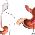 Xác định đúng nguyên nhân viêm loét dạ dày để phòng ngừa và điều trị hiệu quả