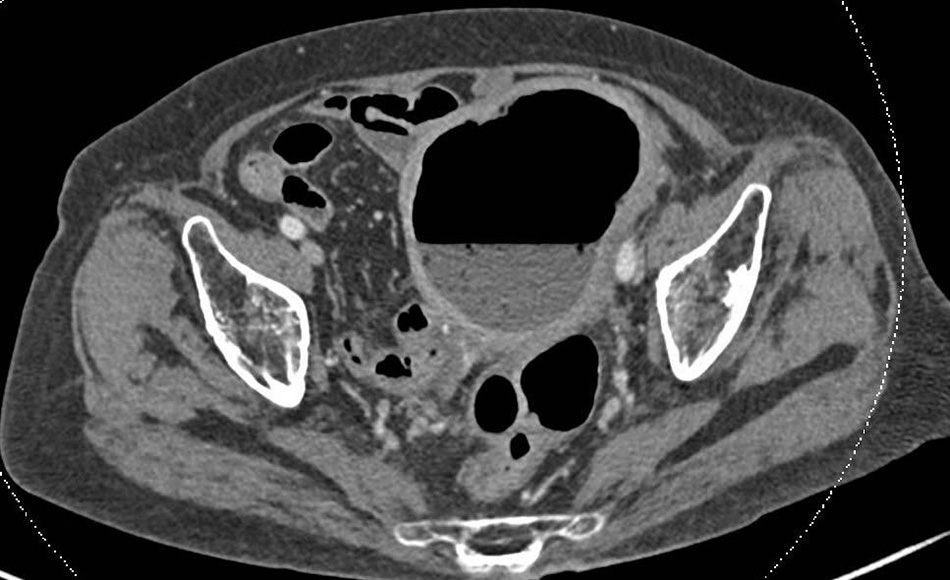 The CT scan revealed an abnormally enlarged uterus containing a significant amount of gas and fluid.