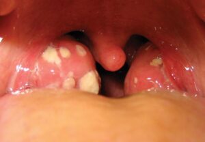 Viêm Amidan là gì? Thông tin quan trọng cần biết về viêm amidan