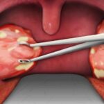 Viêm amidan hốc mủ là gì? Nguyên nhân, triệu chứng, chẩn đoán, điều trị