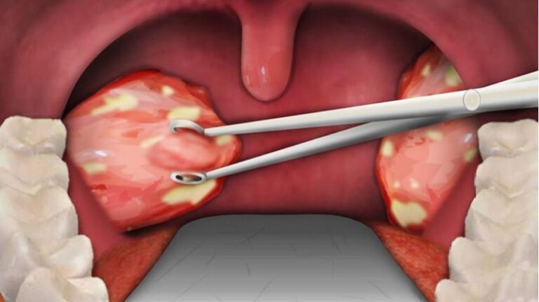 Viêm amidan hốc mủ là gì? Nguyên nhân, triệu chứng, chẩn đoán, điều trị