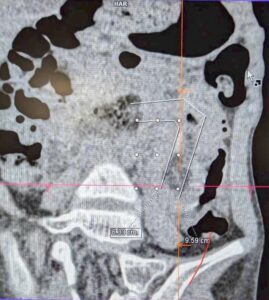 Nine-Year-Old Girl Hospitalised with Intestinal Obstruction Caused by a Nearly One-Metre-Long Hairball