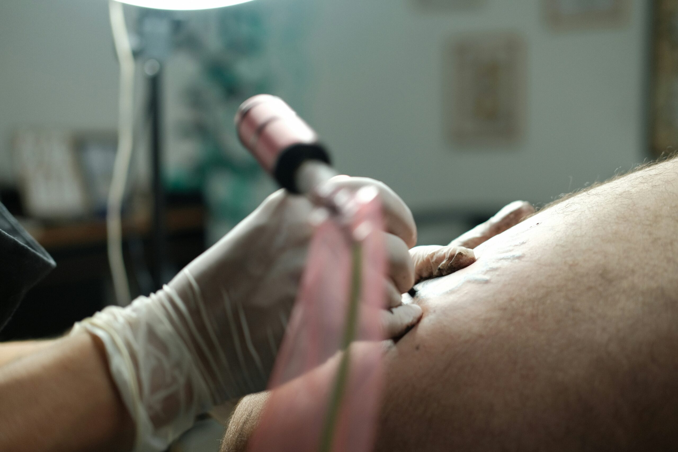 Laser tattoo removal treatment