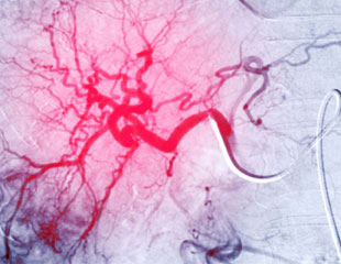 Transarterial Chemoembolisation (TACE) for Liver Cancer