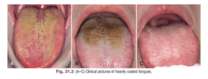 BAD BREATH – AN EARLY SIGN OF SYSTEMIC DISEASES
