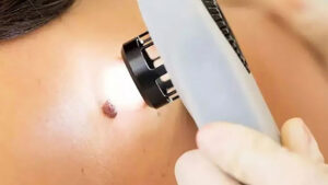 Frequent direct exposure to sunlight is a leading cause of skin cancer